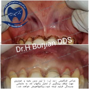 جراحة استئصال اللجام من أفضل طبيب أسنان في أصفهان