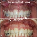 Removal of dark gums with laser (Laser depigmentation) !