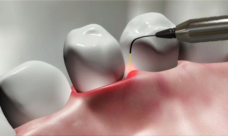 آیا ایمپلنت با لیزر، بدون بخیه و خونریزی است؟ | بهترین دندانپزشک اصفهان