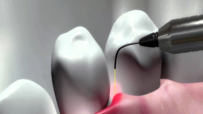 Is the laser implant without stitches and bleeding? | The best dentist in Isfahan