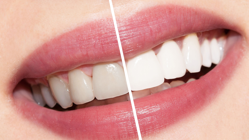 Types of bleaching and advantages and disadvantages | The best dentist in Isfahan