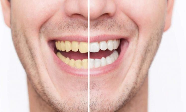 Bleaching (teeth whitening) with a laser | The best dentist in Isfahan