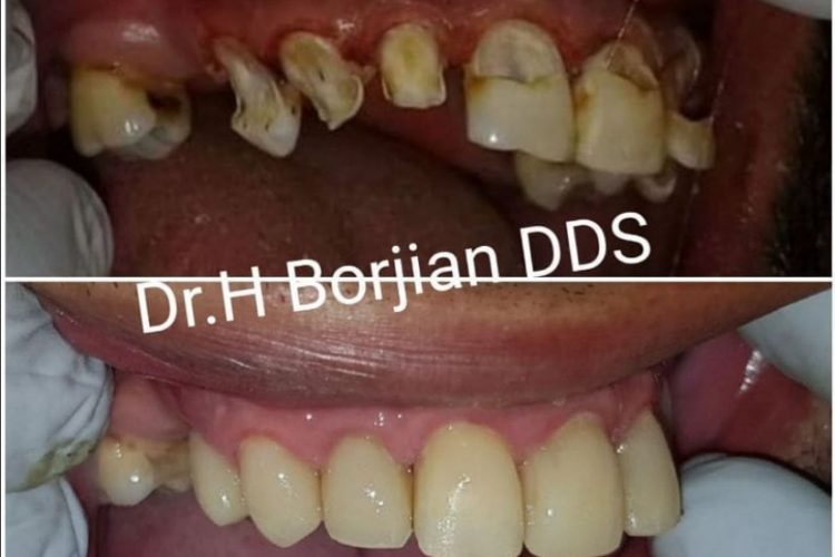 ترمیم های مستقیم دندانی (پُر کردن) دکتر حسبن برجیان