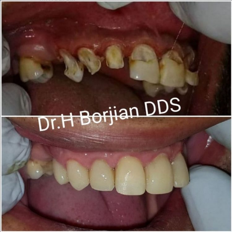 ترمیم های مستقیم دندانی (پُر کردن) دکتر حسبن برجیان
