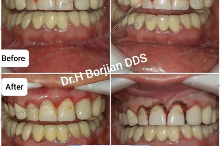 Sutureless surgeries and mouth bleeding by Dr. Hossein Borjian