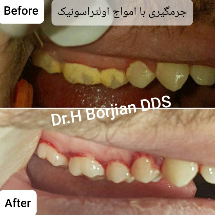 جرمگیری با امواج اولتراسونیک | بهترین دندانپزشک زیبایی اصفهان