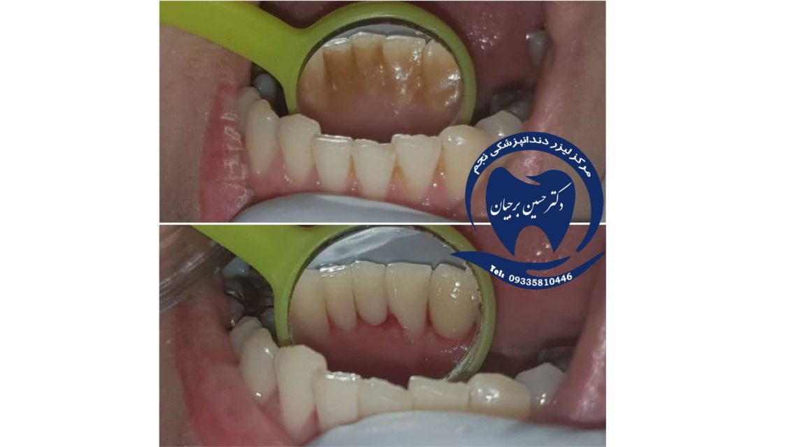 جرمگیری با امواج اولتراسونیک | بهترین دندانپزشک اصفهان