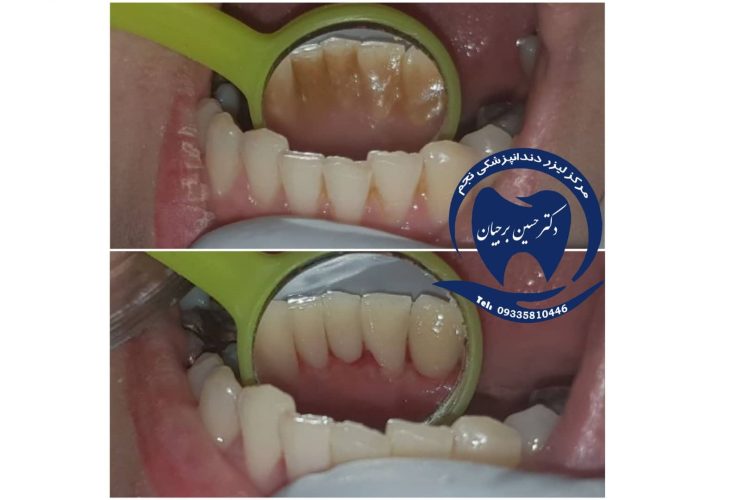 Scaling with ultrasonic waves | The best dentist in Isfahan