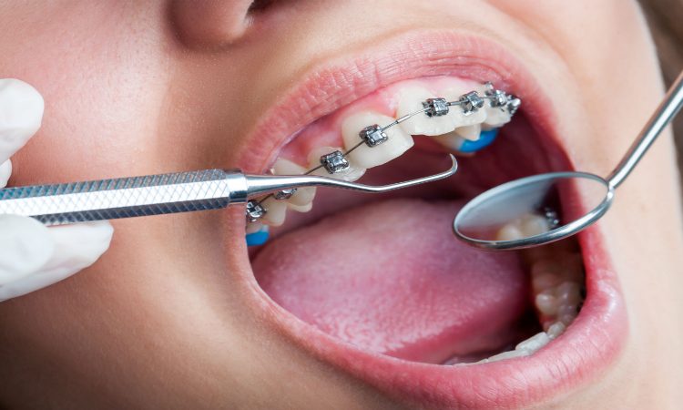 مشکلات مفصل گیجگاهی فکی | بهترین دندانپزشک اصفهان