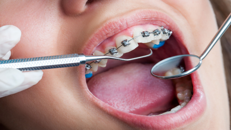 مشکلات مفصل گیجگاهی فکی | بهترین دندانپزشک اصفهان