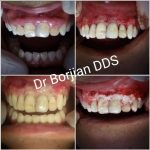Gingivectomie, gingivoplastie, lifting des gencives