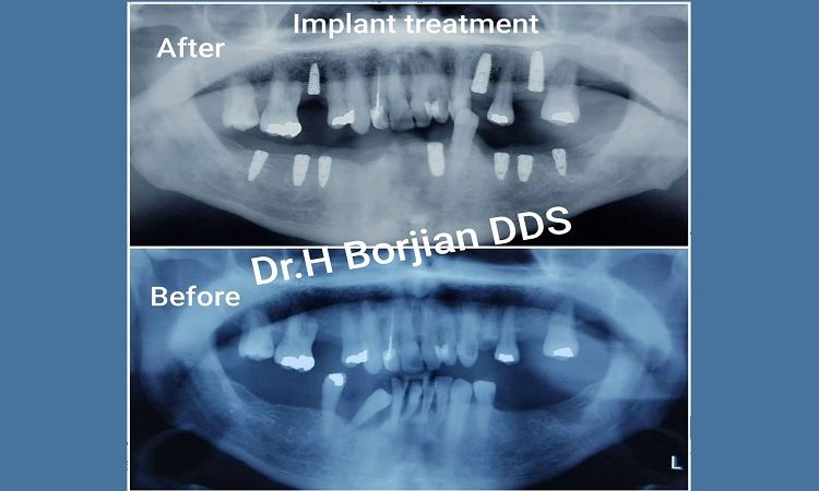 درمان ایمپلنت های دندانی | بهترین جراح لثه اصفهان