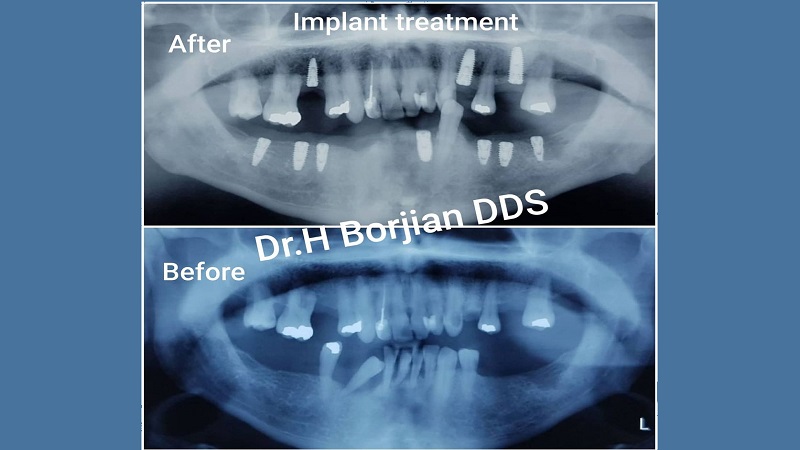 درمان ایمپلنت های دندانی | بهترین جراح لثه اصفهان