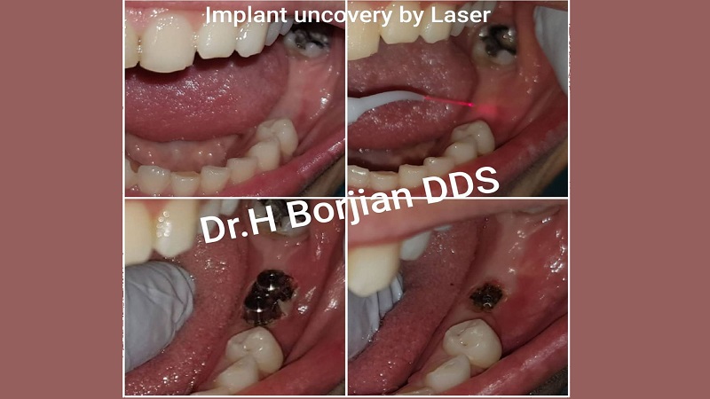 Implant Uncovery By Laser | بهترین ایمپلنت اصفهان
