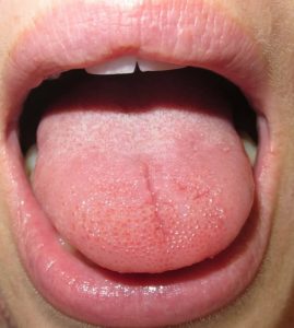 درمان و کنترل سندرم سوزش زبان و دهان | بهترین دندانپزشک اصفهان