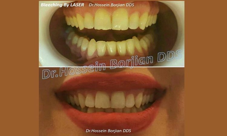 آفیس بلیچینگ ۲۰ دندان قدامی با لیزر | Le meilleur implant à Ispahan