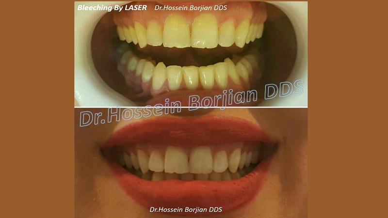 Office bleaching of 20 anterior teeth with laser | The best implant in Isfahan