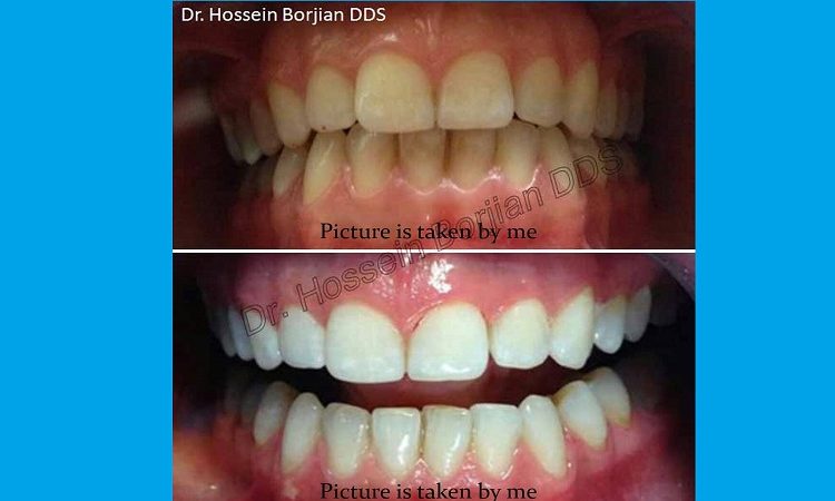 بلیچینگ ( سفید کردن دندان ها ) با لیزر | بهترین دندانپزشک اصفهان