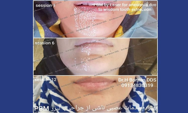 Healing the damage to the nerve branches of the lower jaw | The best gum surgeon in Isfahan