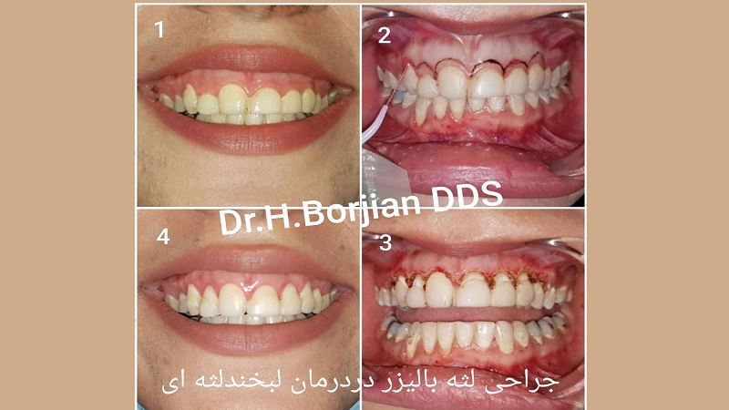 Gum cosmetic surgery using dental laser | The best cosmetic dentist in Isfahan