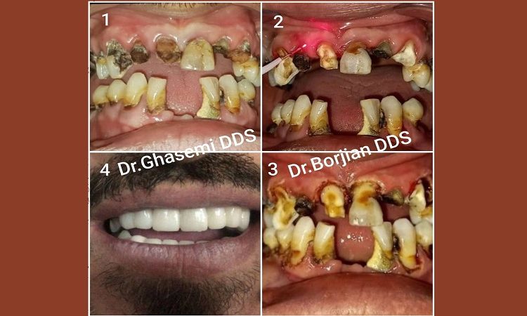 Gum surgery with laser without stitches and bleeding | The best dentist in Isfahan