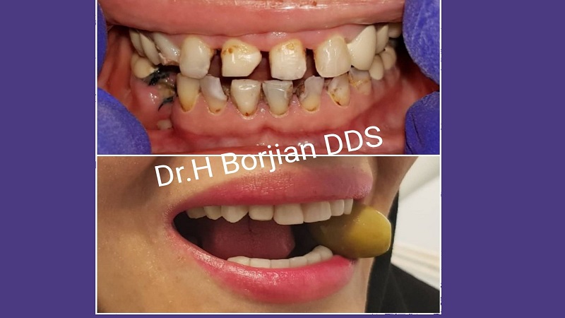 درمان جامع شامل کامپوزیت بیلد آپ و کامپوزیت ونیر زیبایی | بهترین دندانپزشک زیبایی اصفهان