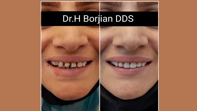 درمان جامع کامپوزیت ونیر زیبایی برای همگی دندان های قدامی فک بالا | بهترین ایمپلنت اصفهان