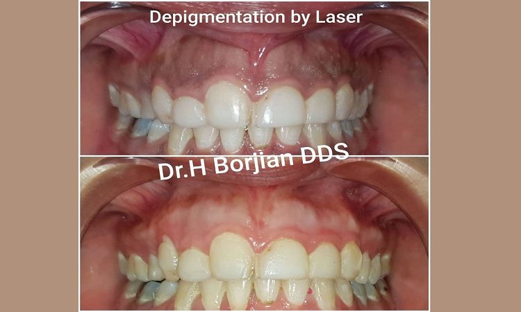 Removal of dark gums with laser | The best gum surgeon in Isfahan