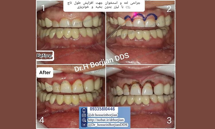 زیبایی لثه با استفاده از لیزر دندانپزشکی | افضل دكتور اسنان تجميلي في اصفهان