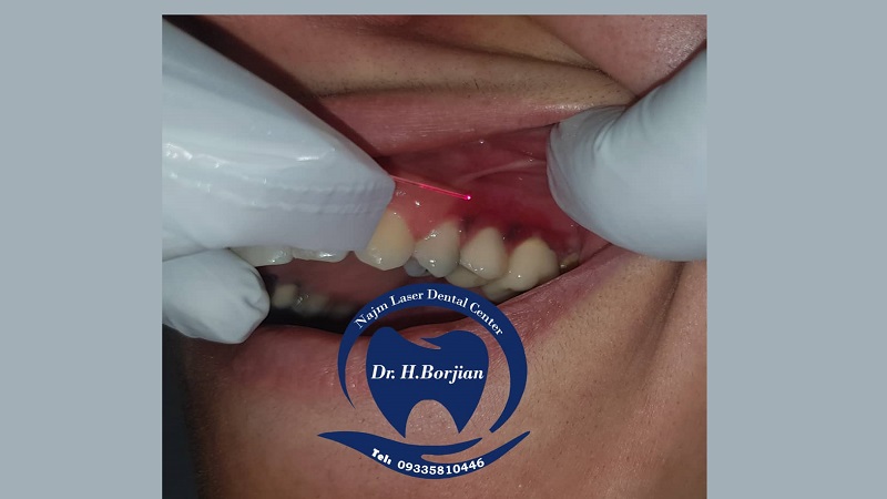 Dual wave length middle infrared high power laser | The best implant in Isfahan