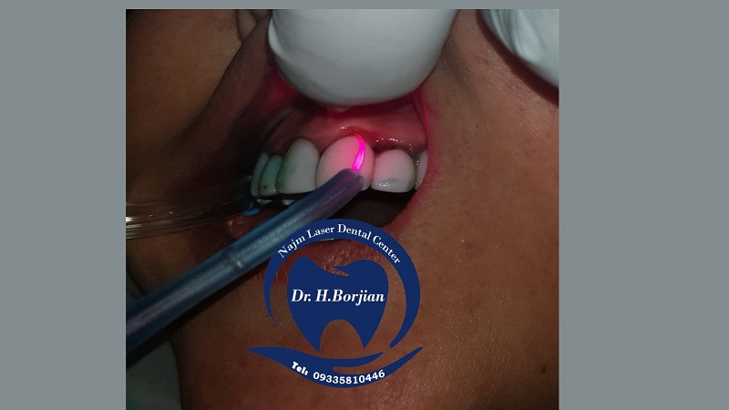 PBM/PDT laser with 2 different wavelengths | The best implant in Isfahan