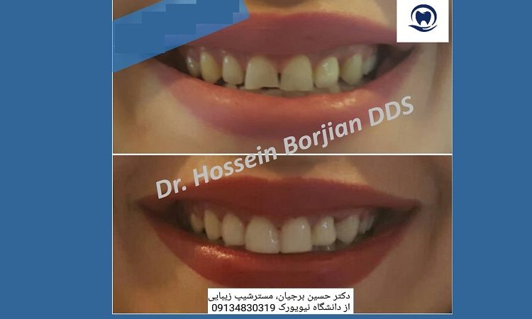 Composite beauty veneer, laser bleaching | The best dentist in Isfahan