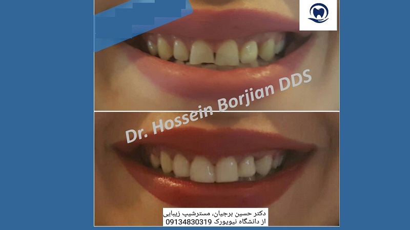 کامپوزیت ونیر زیبایی ، بلیچینگ با لیزر | بهترین دندانپزشک اصفهان