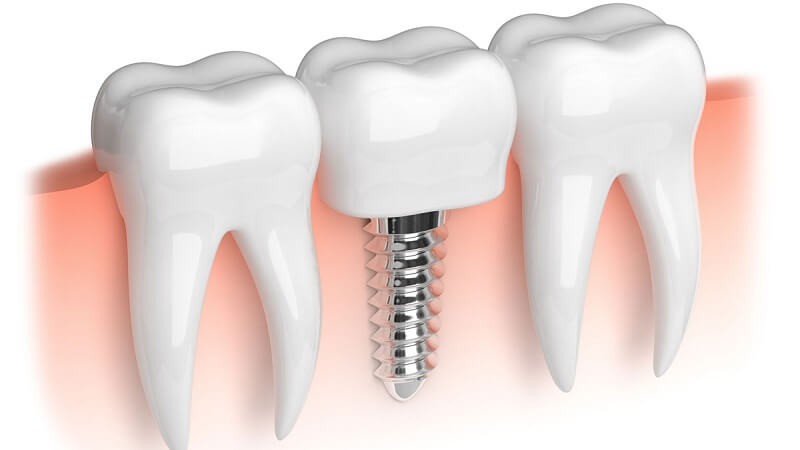 ایمپلنت دندان برای چه افرادی مناسب است؟ | بهترین ایمپلنت اصفهان