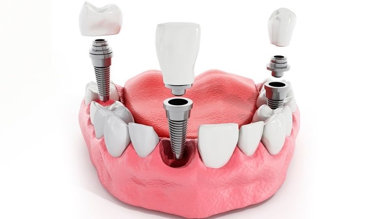 Who are dental implants suitable for? | The best implant in Isfahan
