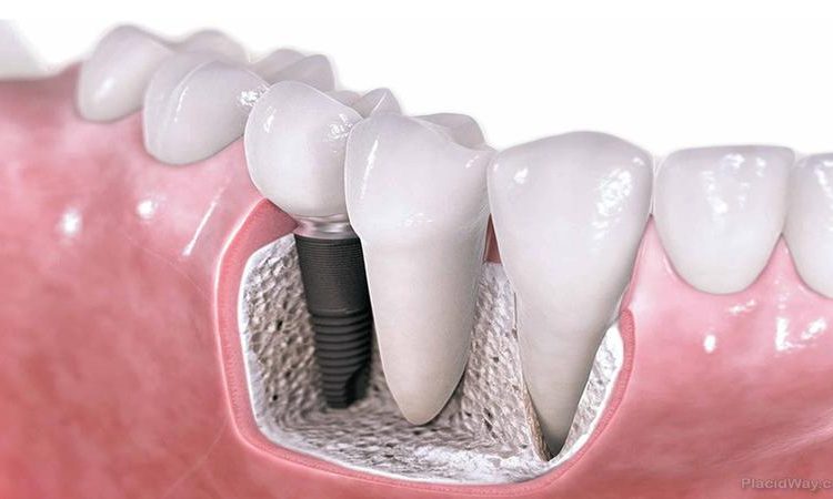 Les implants dentaires ne conviennent pas à qui ? | Le meilleur implant à Ispahan