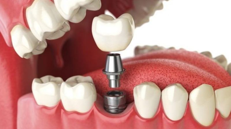 ایمپلنت دندان چیست؟ | بهترین ایمپلنت اصفهان