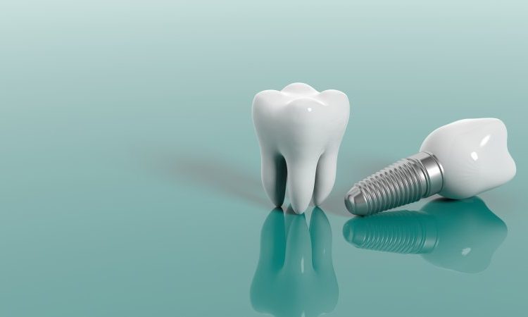 Qu'est-ce qu'un implant dentaire? | Le meilleur implant à Ispahan