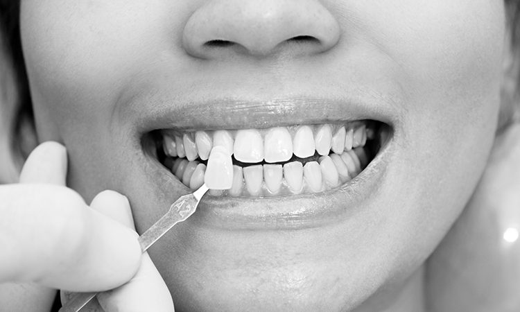 Quelle est la meilleure épaisseur de stratifié dentaire ? | Le meilleur dentiste cosmétique à Ispahan