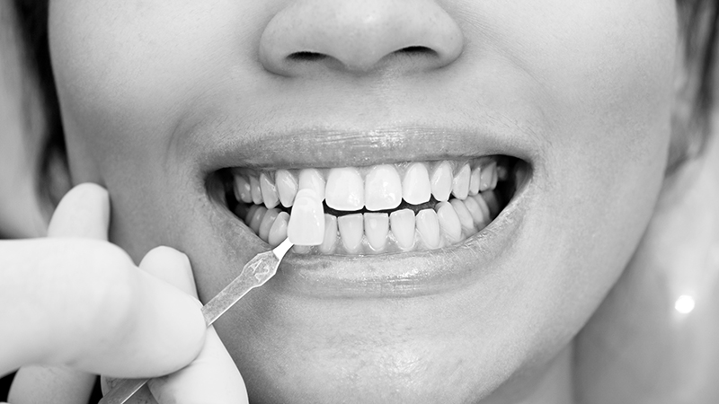 Quelle est la meilleure épaisseur de stratifié dentaire ? | Le meilleur dentiste cosmétique à Ispahan
