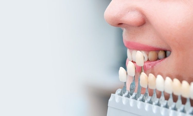 ما هي قشرة الاسنان؟ | افضل دكتور اسنان في اصفهان
