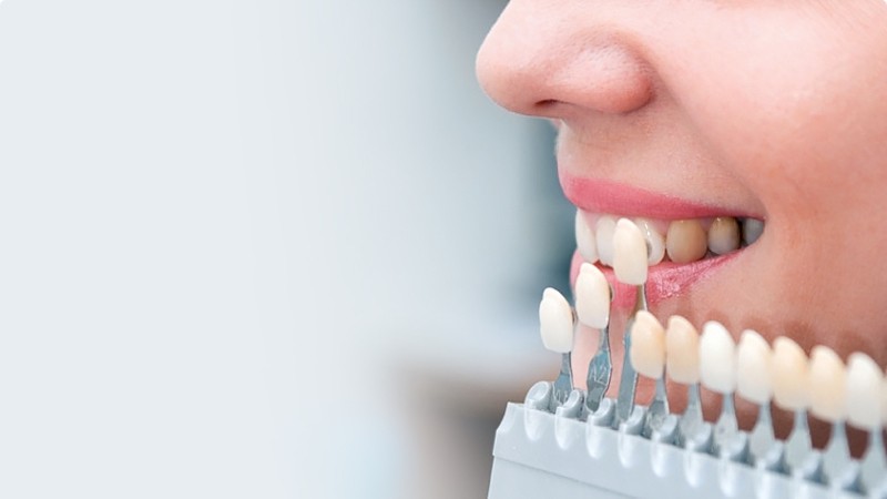 What is dental veneer? | The best dentist in Isfahan