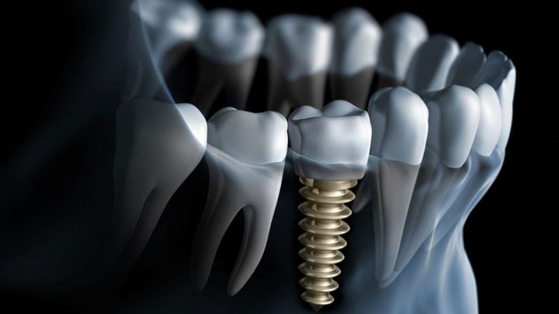 Complications of not combining the implant with the bone | The best implant in Isfahan