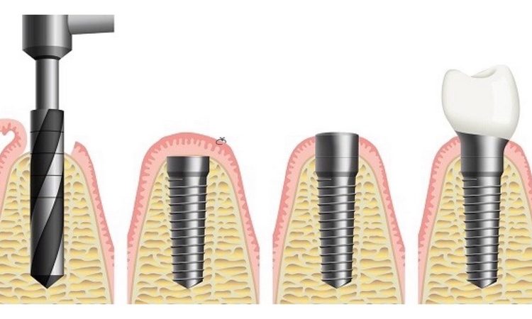 مزایا و معایب ایمپلنت دندان فوری چیست؟ | The best gum surgeon in Isfahan