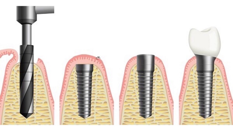 مزایا و معایب ایمپلنت دندان فوری چیست؟ | بهترین جراح لثه اصفهان