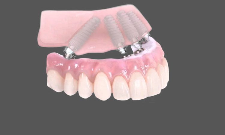 انواع ایمپلنت دندان | Le meilleur implant à Ispahan