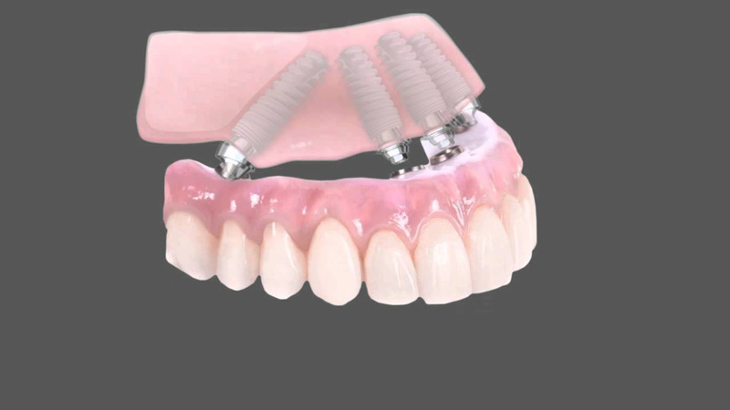 انواع ایمپلنت دندان | بهترین ایمپلنت اصفهان