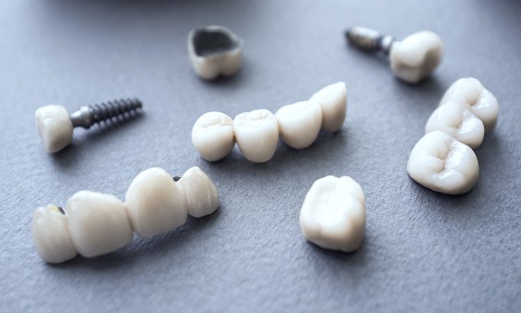 انواع روش های ایمپلنت دندان چیست؟ | بهترین ایمپلنت اصفهان