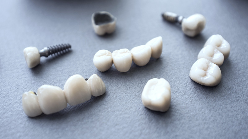 انواع روش های ایمپلنت دندان چیست؟ | بهترین ایمپلنت اصفهان