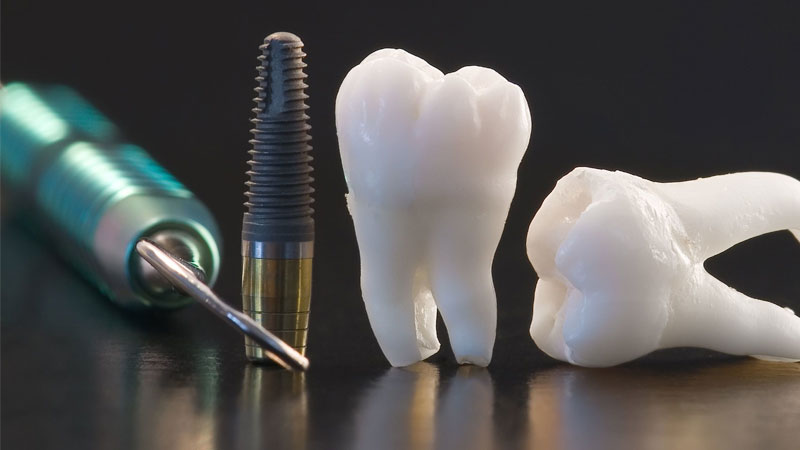One-day or immediate dental implant | The best implant in Isfahan